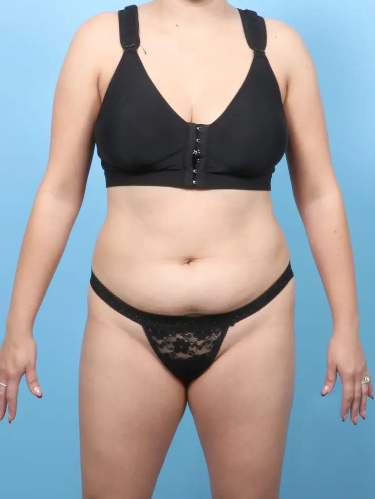 Liposuction - Case 63236 - Before
