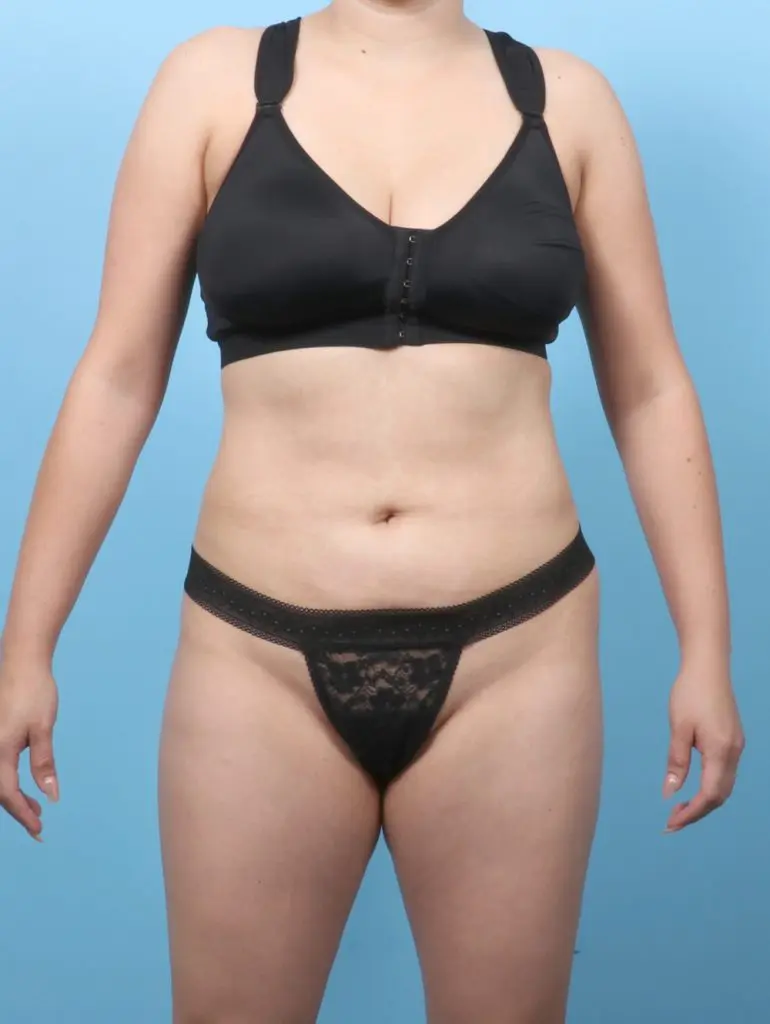 Liposuction - Case 63236 - After