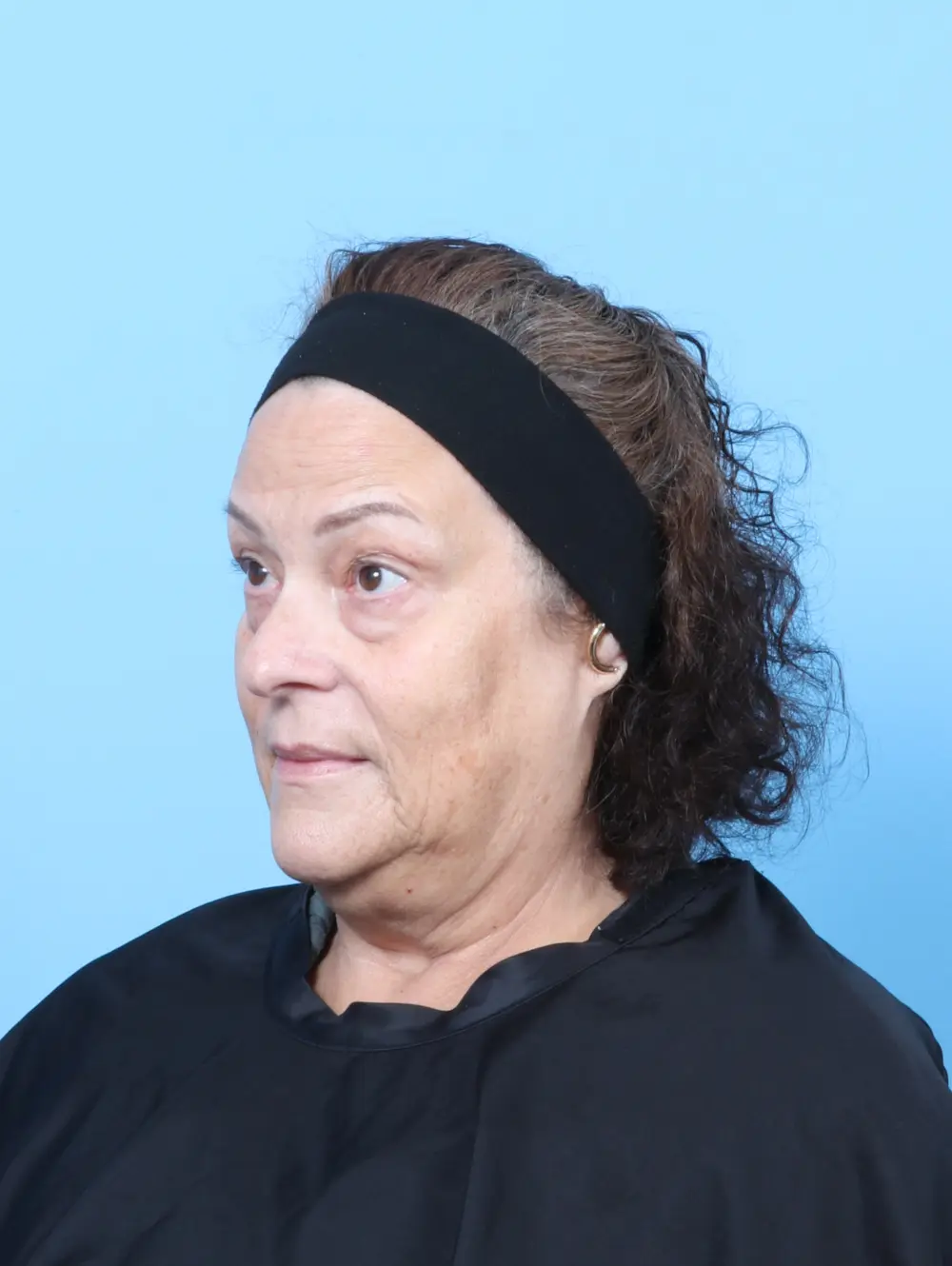 Eyelid Surgery Patient Photo - Case 63246 - before view-1