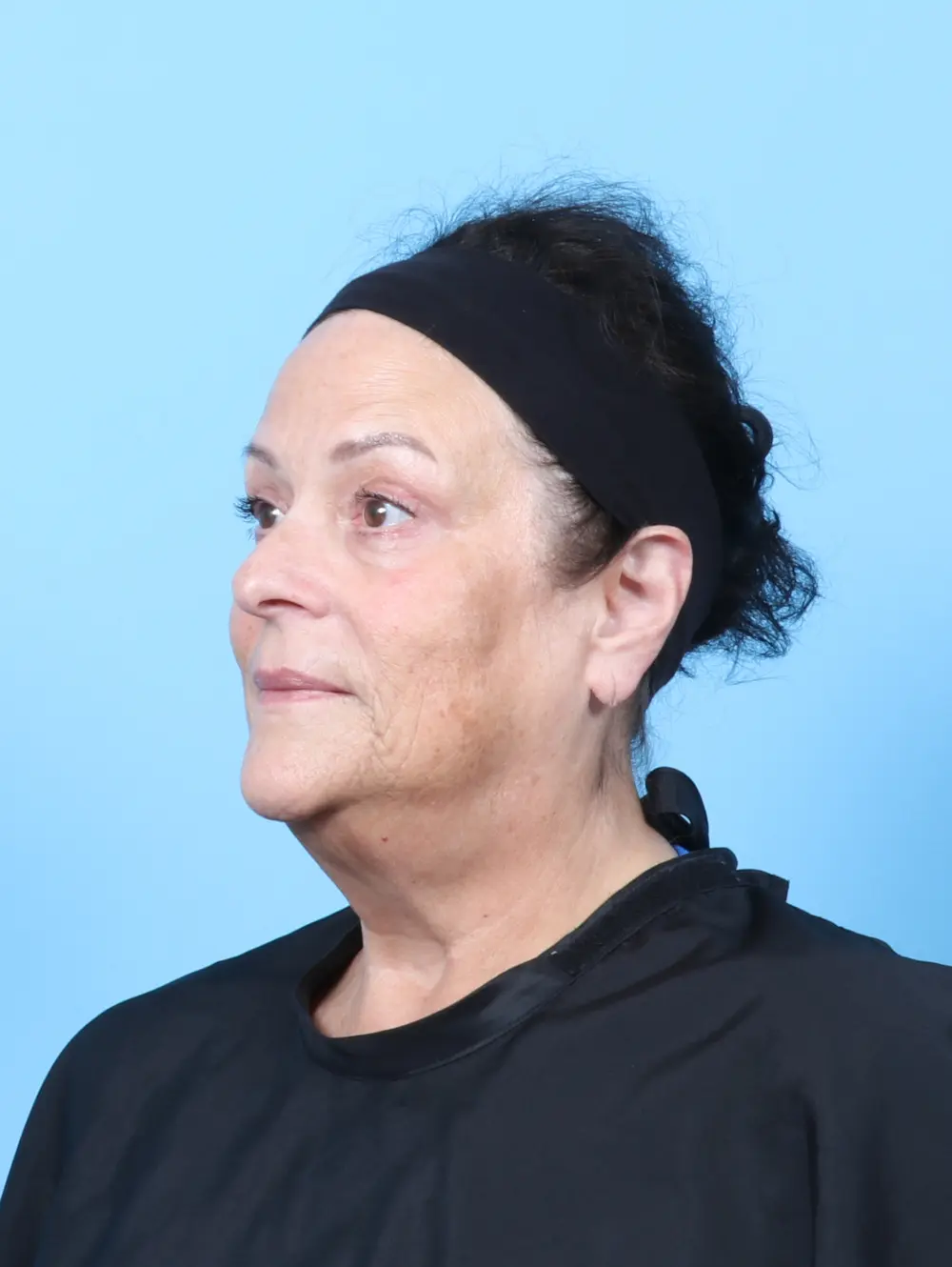 Eyelid Surgery Patient Photo - Case 63246 - after view-1