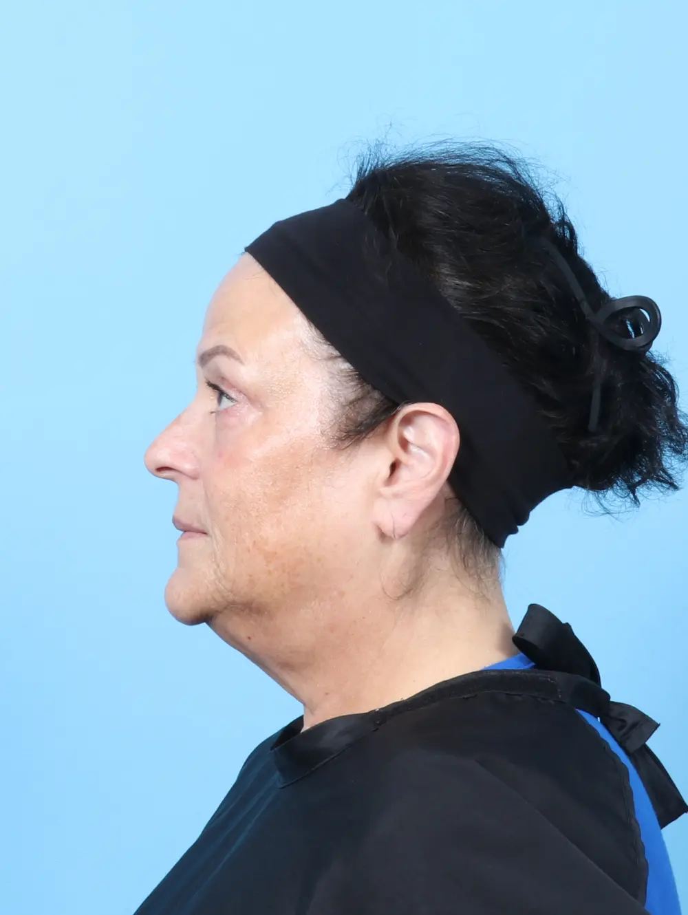 Eyelid Surgery Patient Photo - Case 63246 - after view-2
