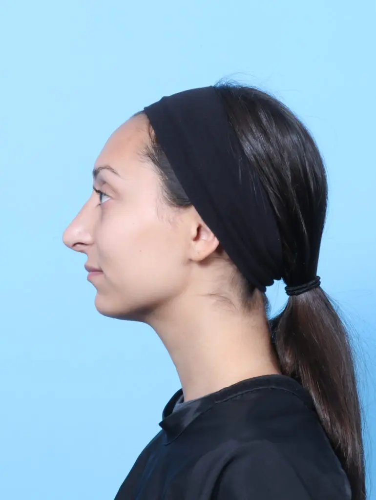 Rhinoplasty - Case 63309 - After