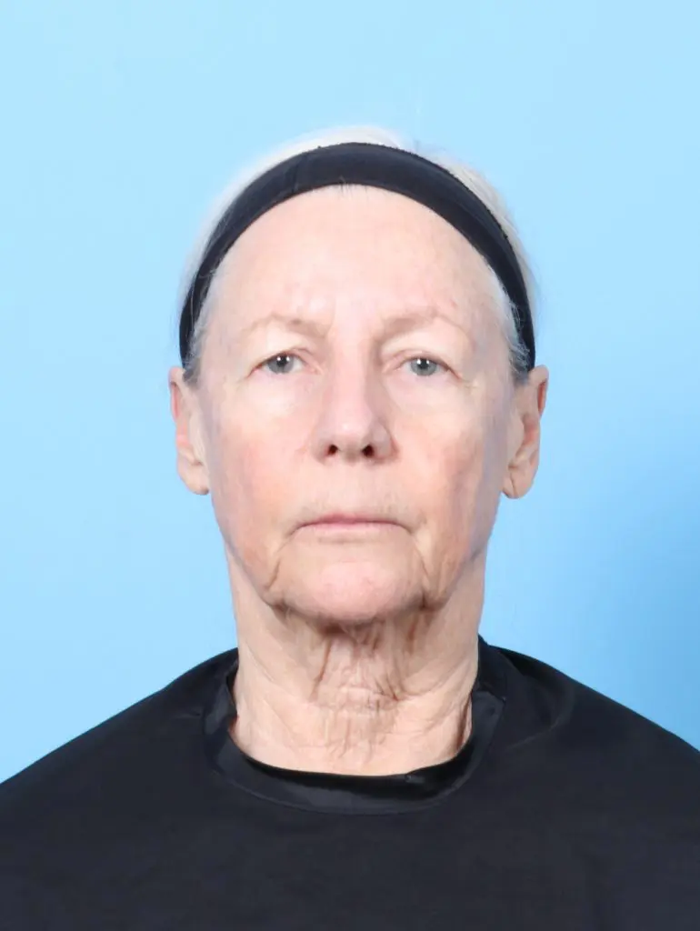 Eyelid Surgery - Case 63342 - Before