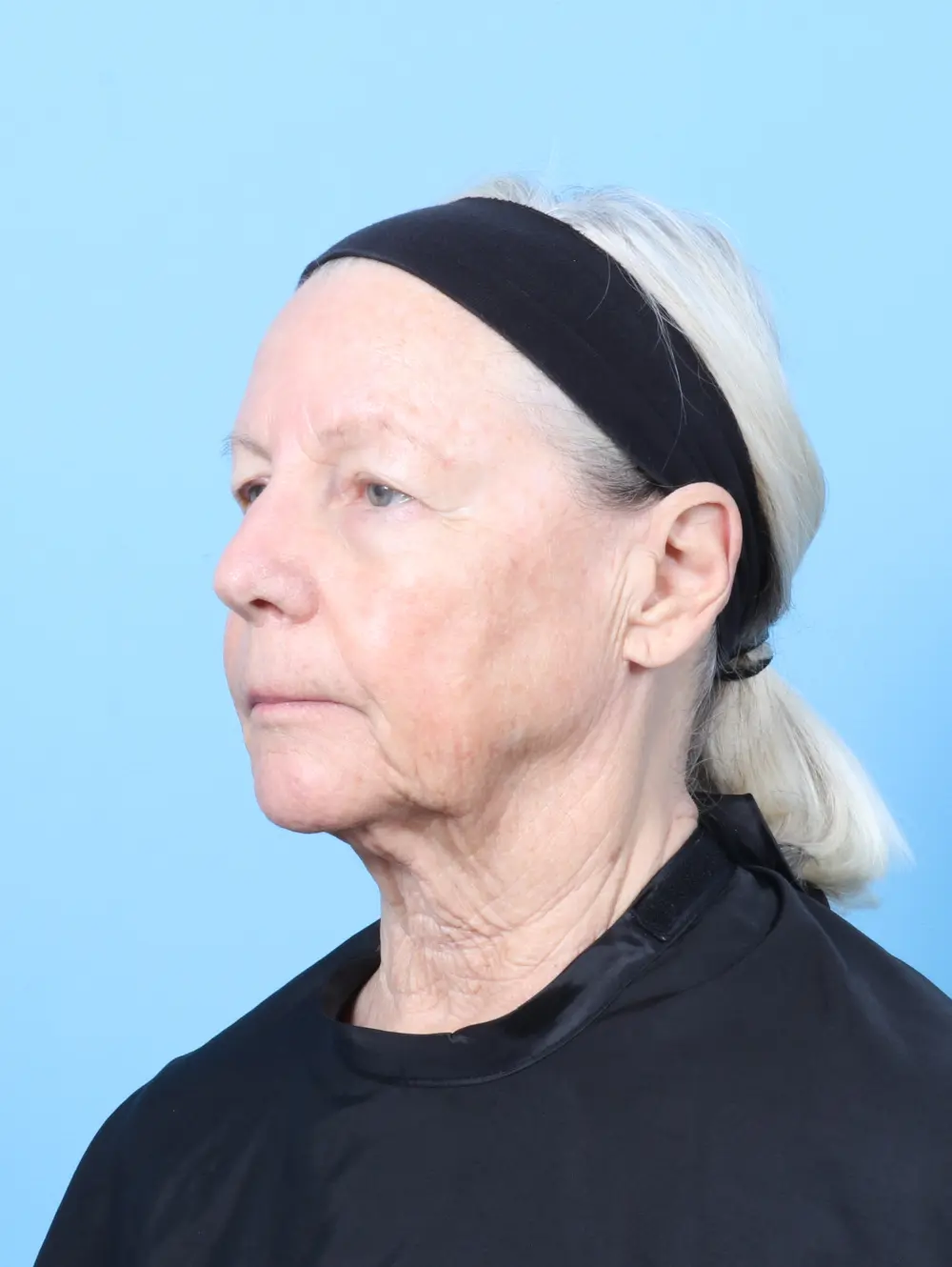 Eyelid Surgery Patient Photo - Case 63342 - before view-1