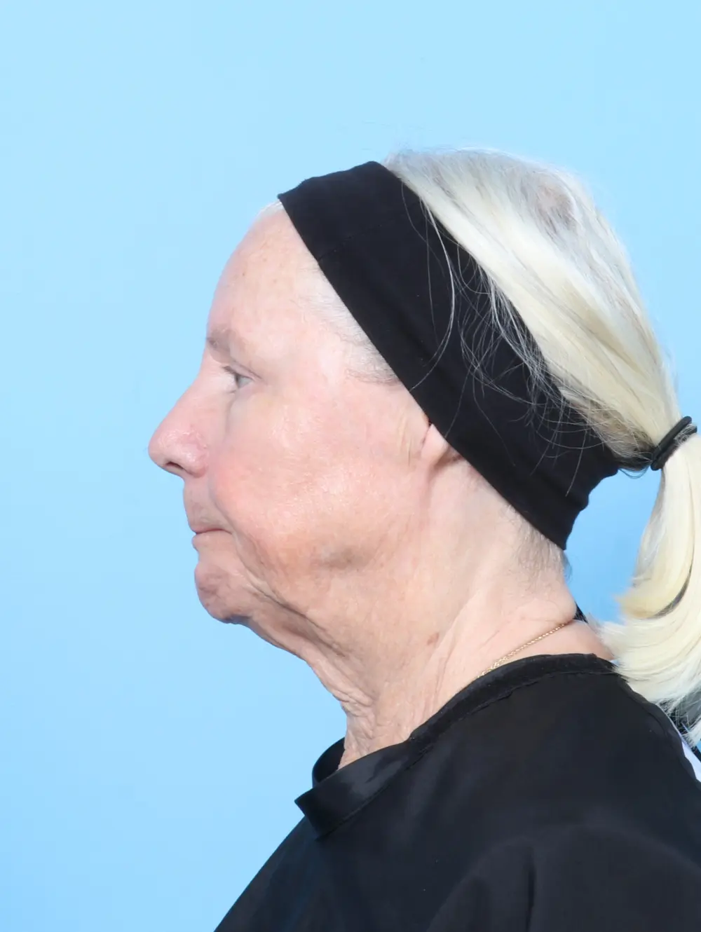Eyelid Surgery Patient Photo - Case 63342 - after view-2