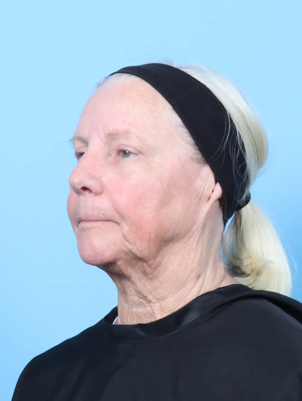 Eyelid Surgery Patient Photo - Case 63342 - after view-1