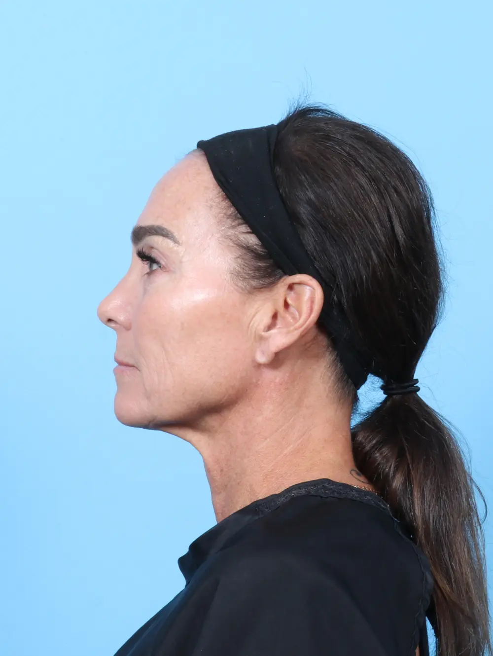Bullhorn Lip Lift Patient Photo - Case 63645 - before view-2
