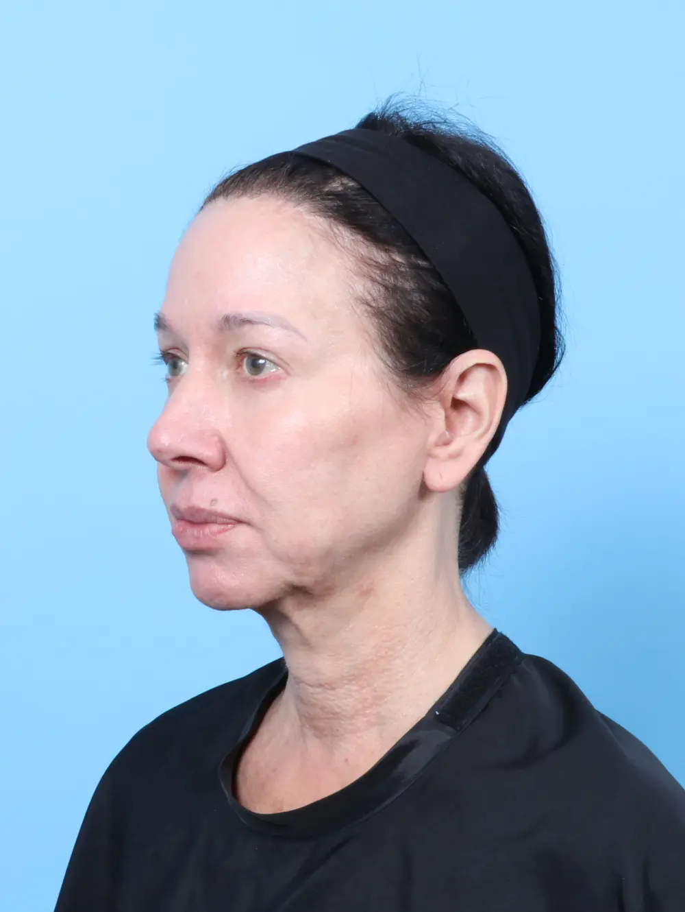 Bullhorn Lip Lift Patient Photo - Case 63730 - before view-1