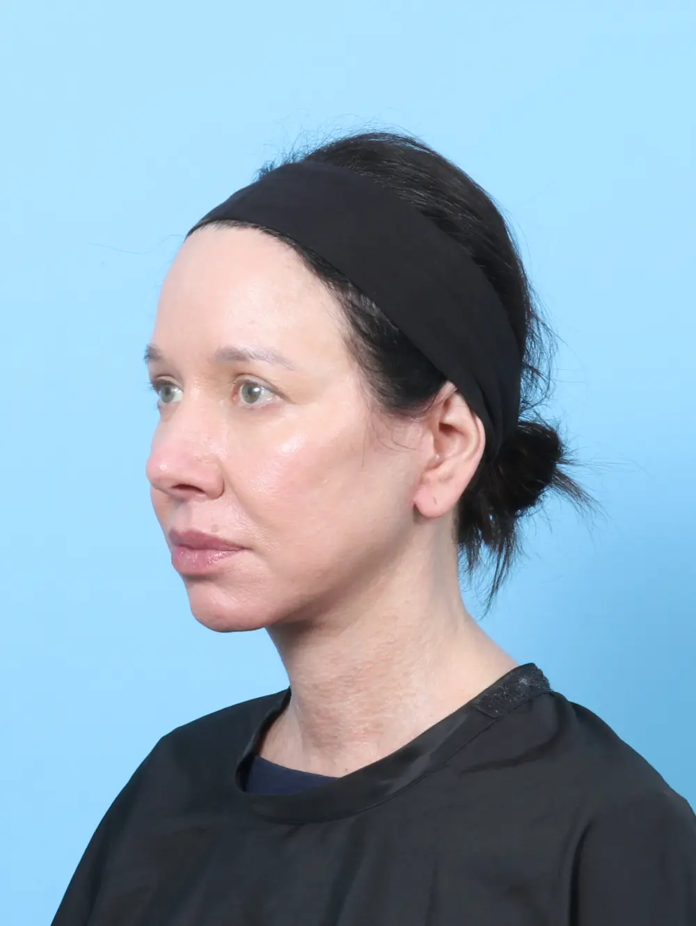 Bullhorn Lip Lift Patient Photo - Case 63730 - after view-1