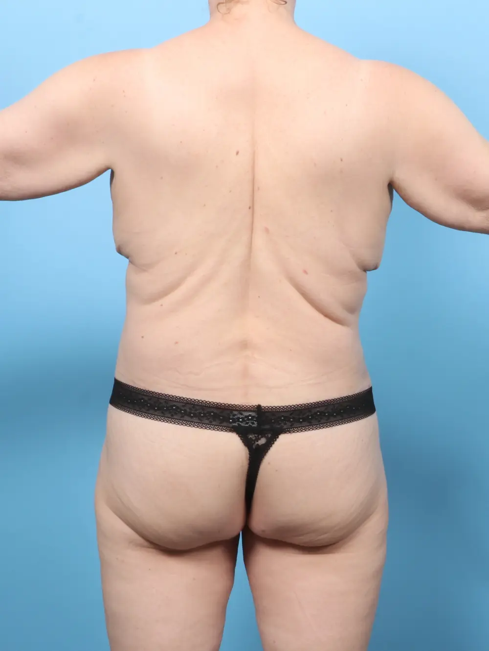 After Weight Loss Patient Photo - Case 63758 - after view-3
