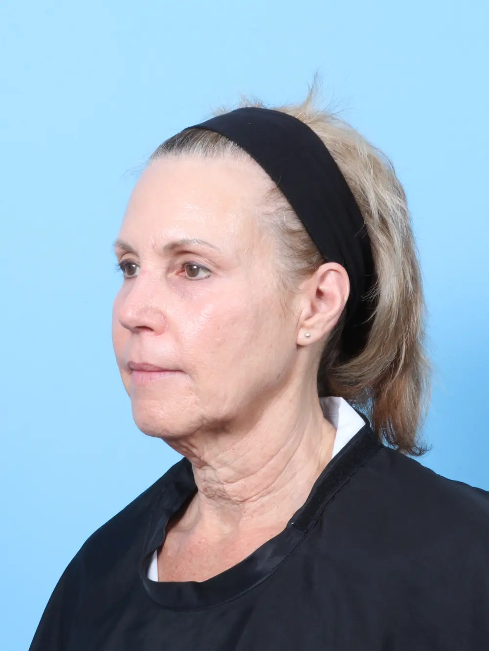 Brow Lift Patient Photo - Case 63775 - before view-1