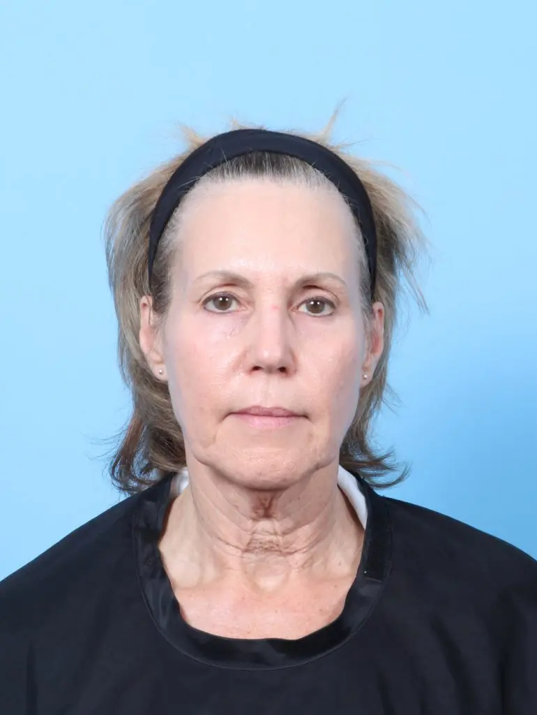 Brow Lift - Case 63775 - Before