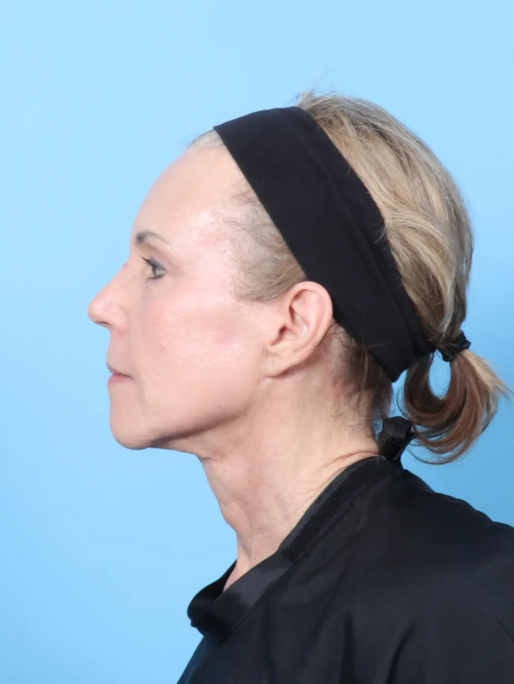 Brow Lift Patient Photo - Case 63775 - after view-2
