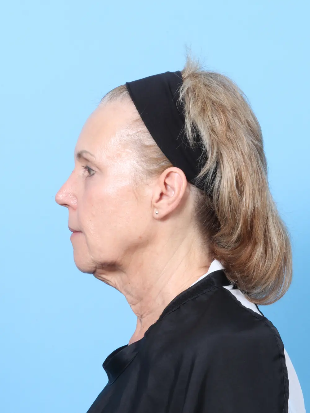 Brow Lift Patient Photo - Case 63775 - before view-2