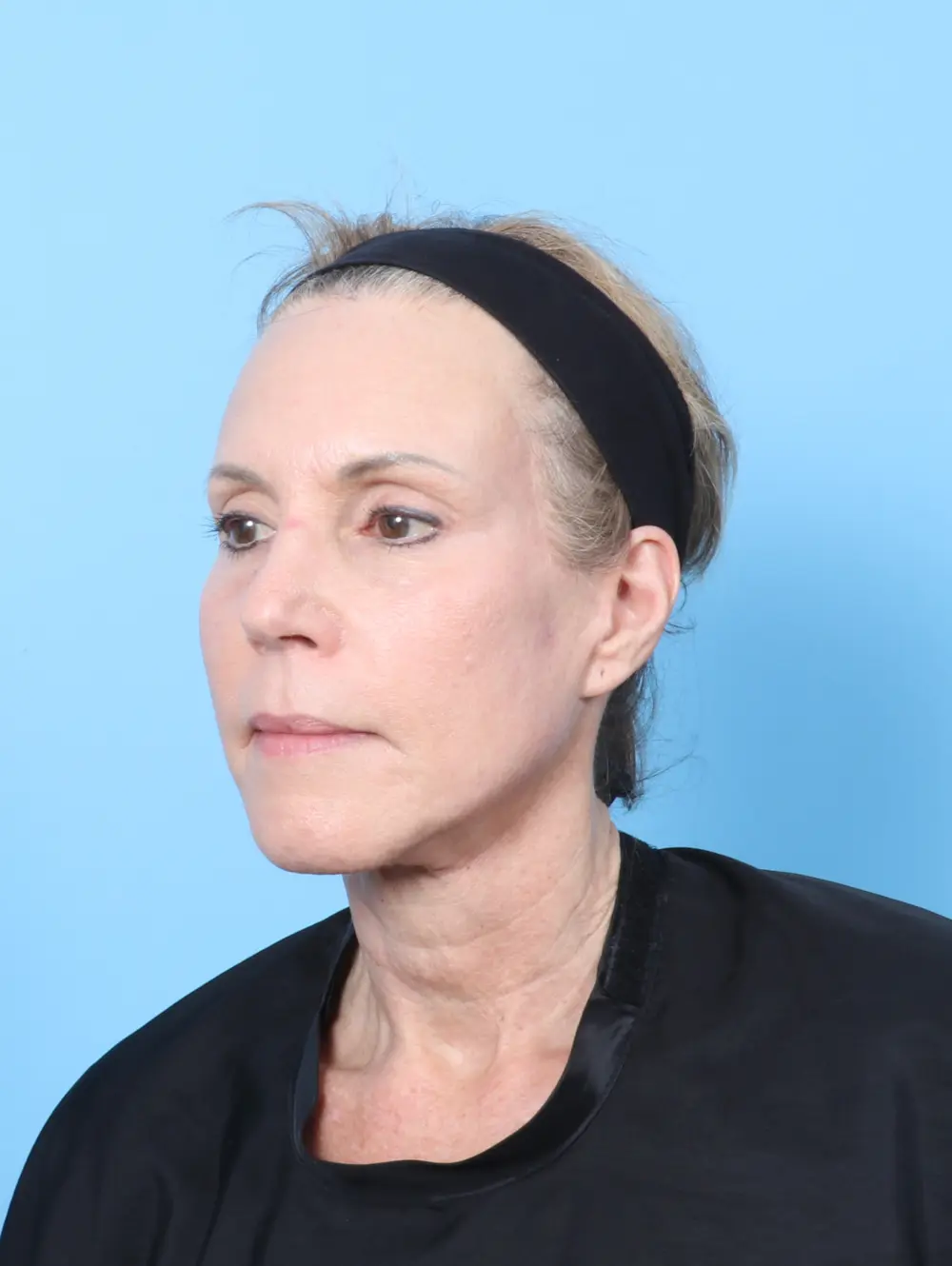 Brow Lift Patient Photo - Case 63775 - after view-1