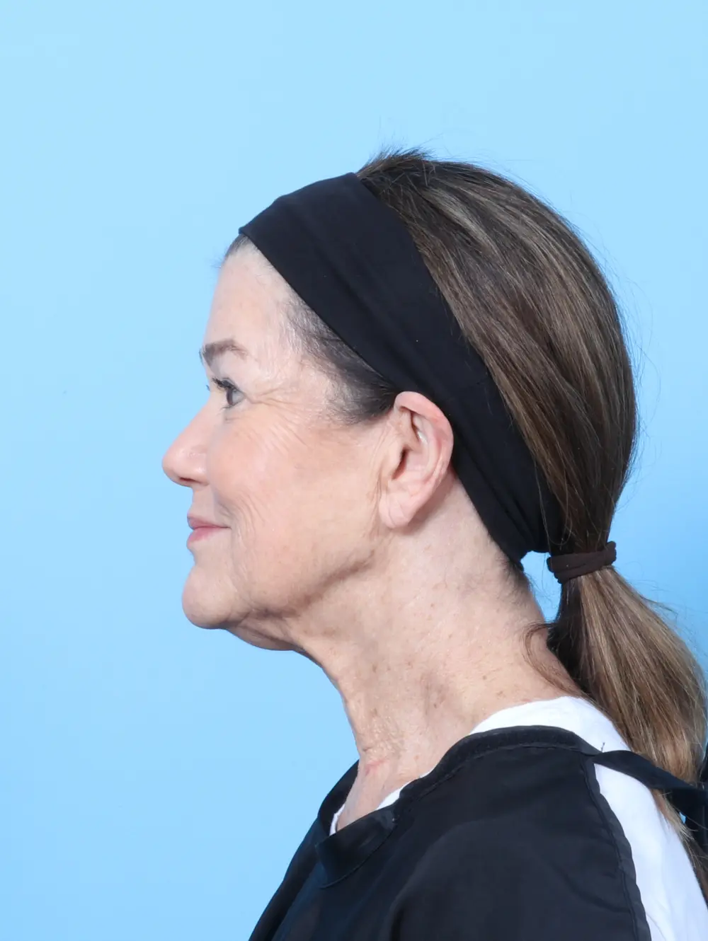 Facelift / Neck Lift Patient Photo - Case 63862 - before view-2