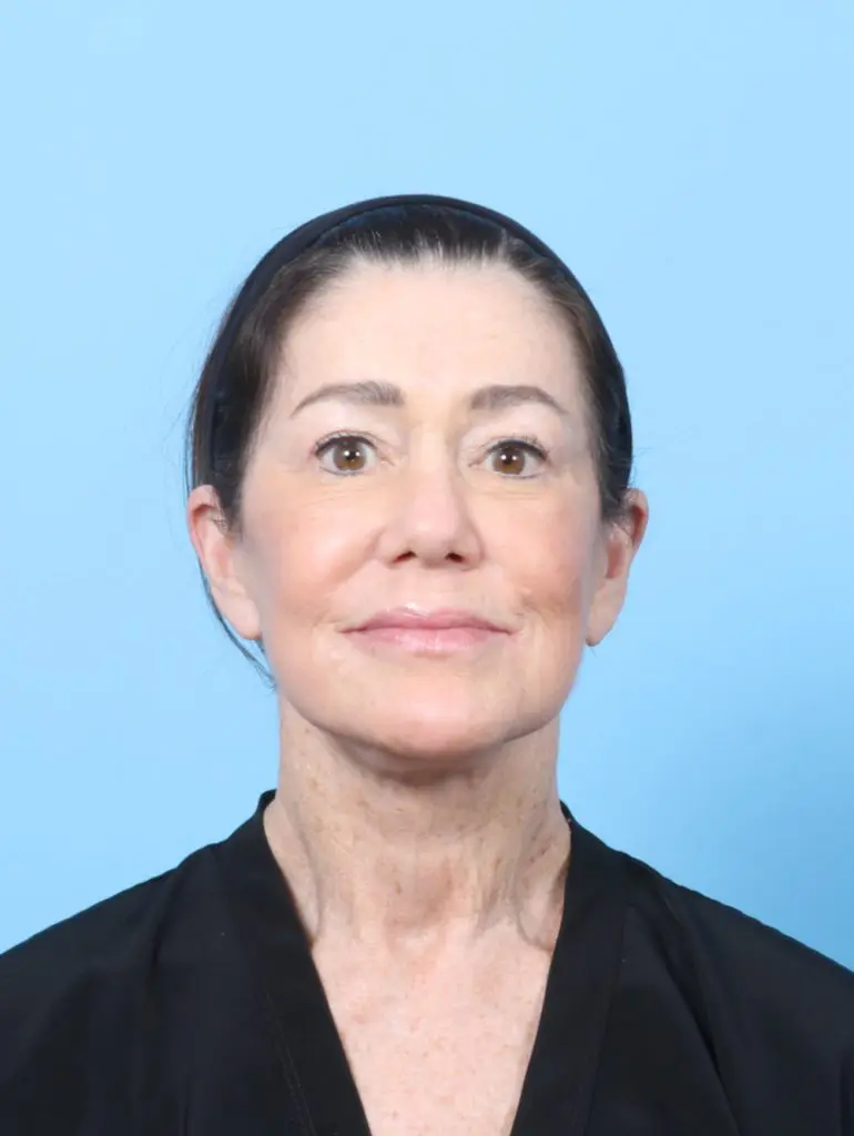 Facelift / Neck Lift - Case 63862 - After