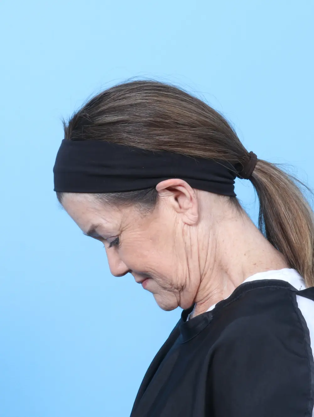 Facelift / Neck Lift Patient Photo - Case 63862 - before view-3