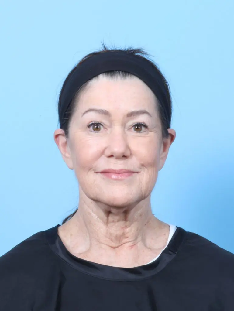 Facelift / Neck Lift - Case 63862 - Before