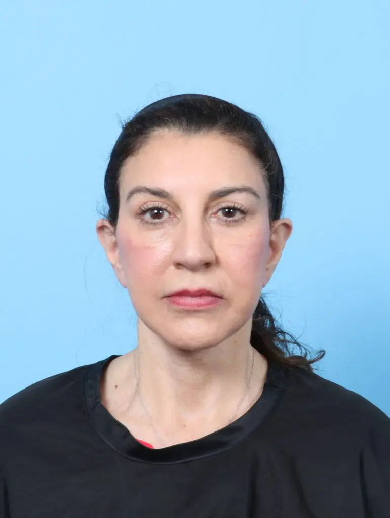 Brow Lift - Case 63875 - After