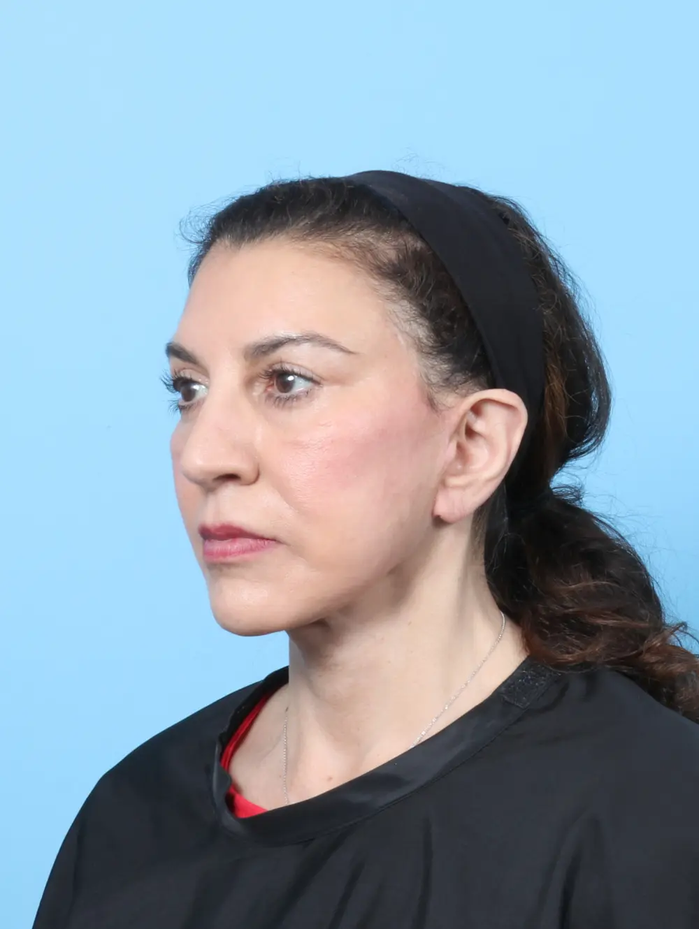 Brow Lift Patient Photo - Case 63875 - after view-1