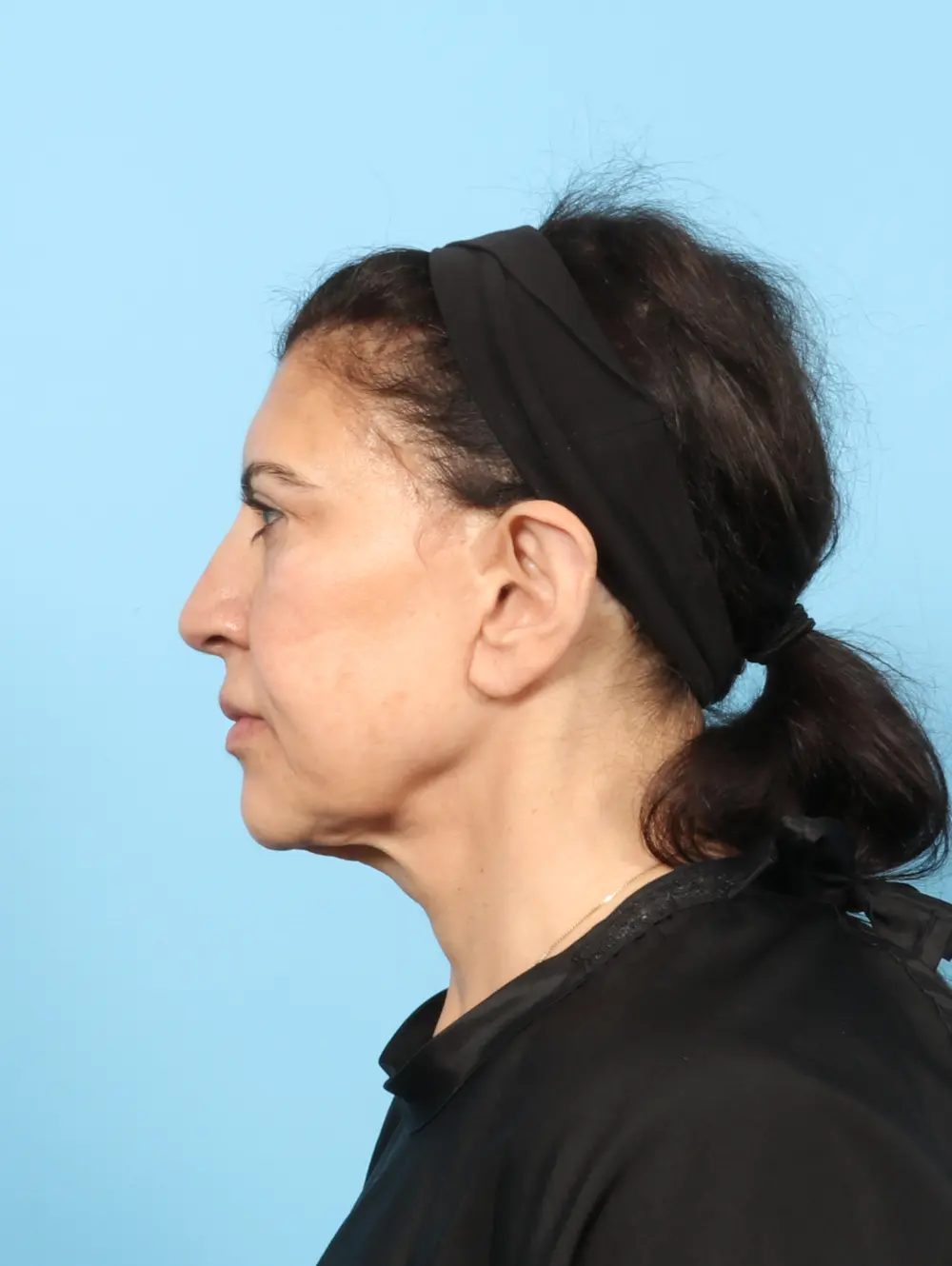 Brow Lift Patient Photo - Case 63875 - before view-2