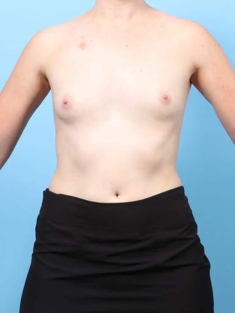 Breast Augmentation - Case 63921 - Before