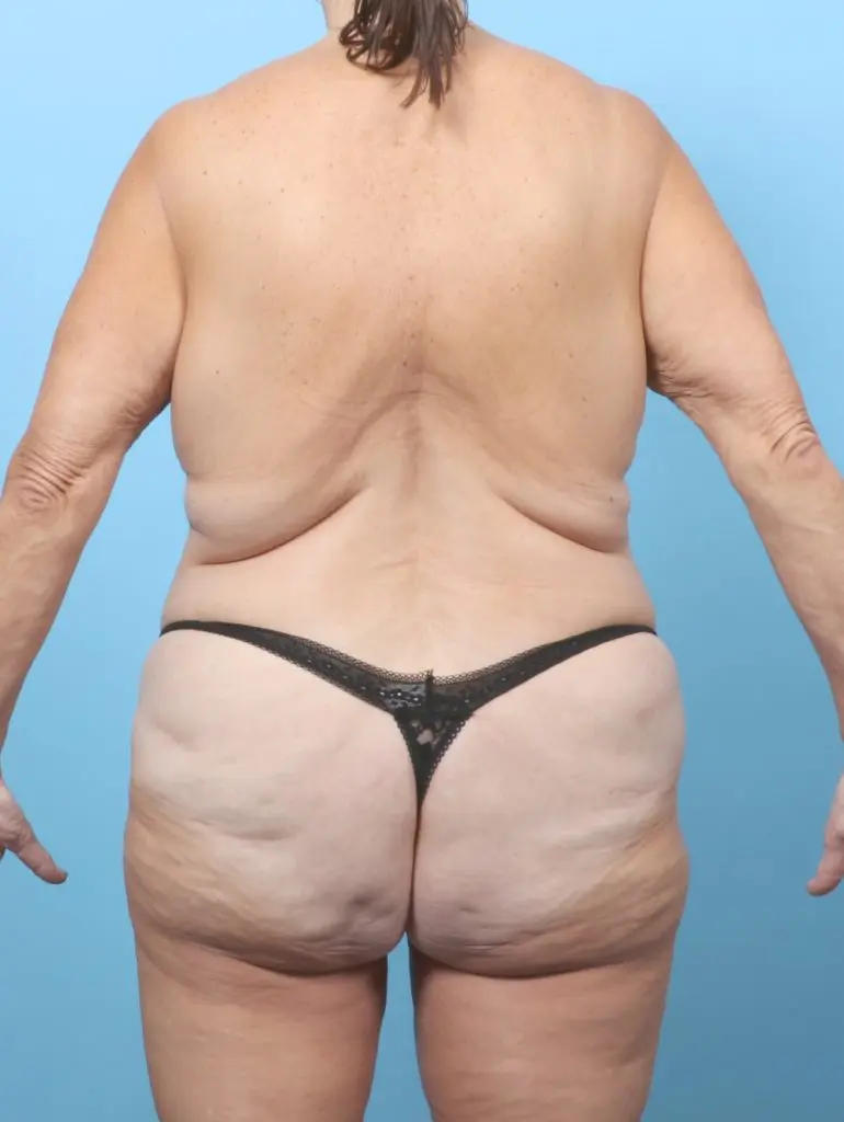 After Weight Loss - Case 63939 - Before