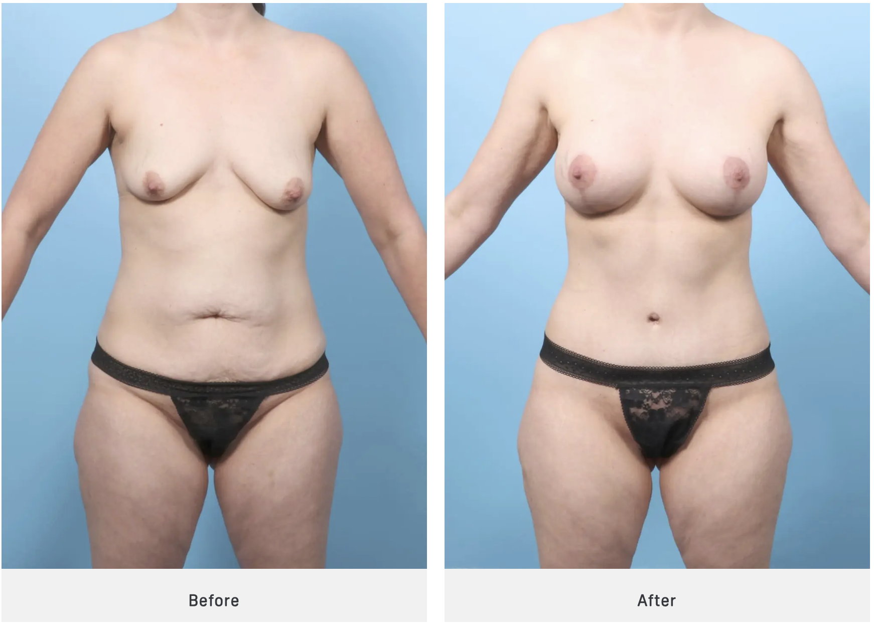 tummy tuck case 2
