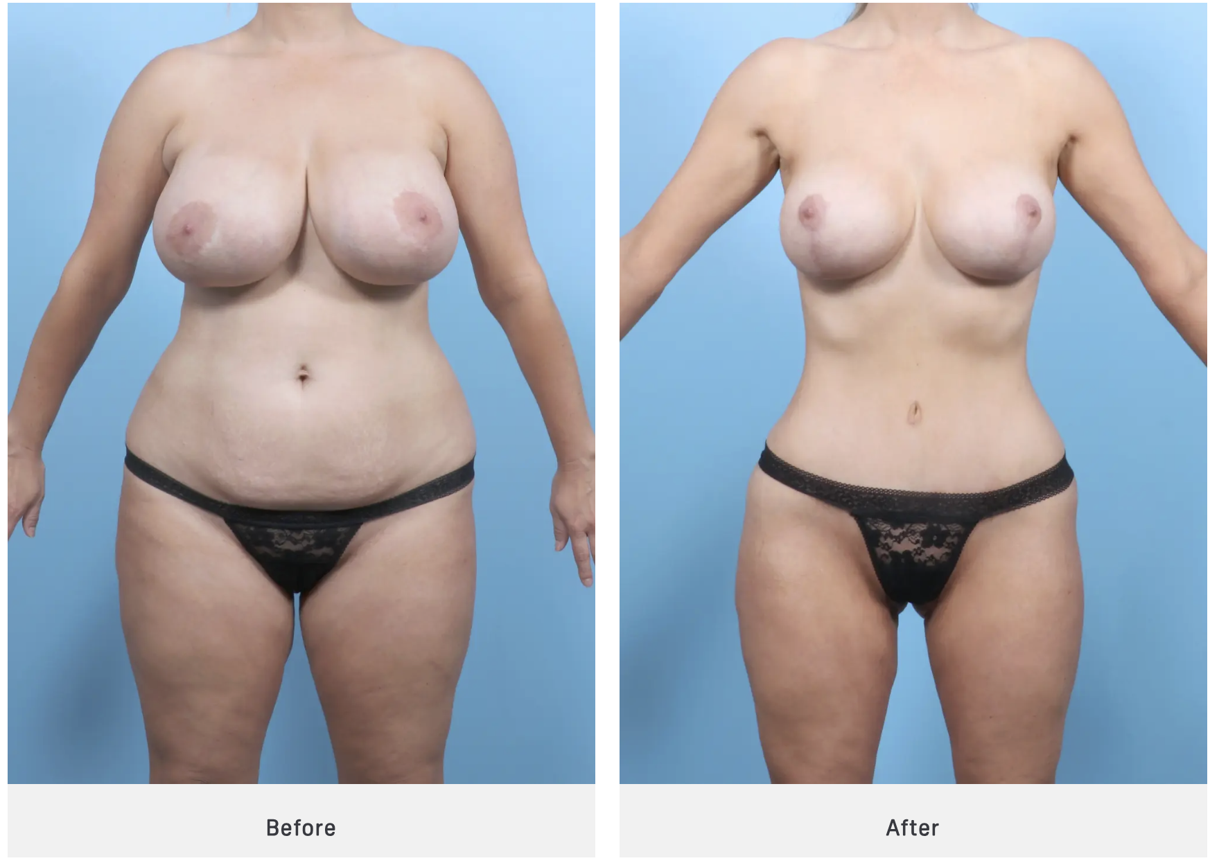 tummy tuck case 3