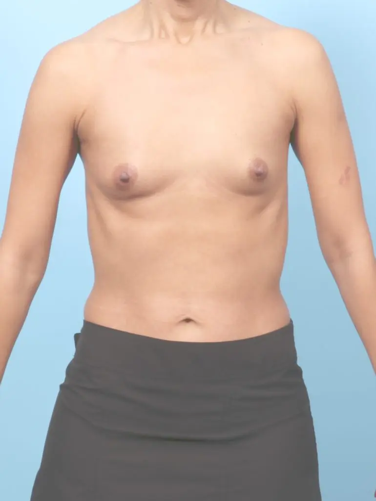 Breast Augmentation - Case 64004 - Before