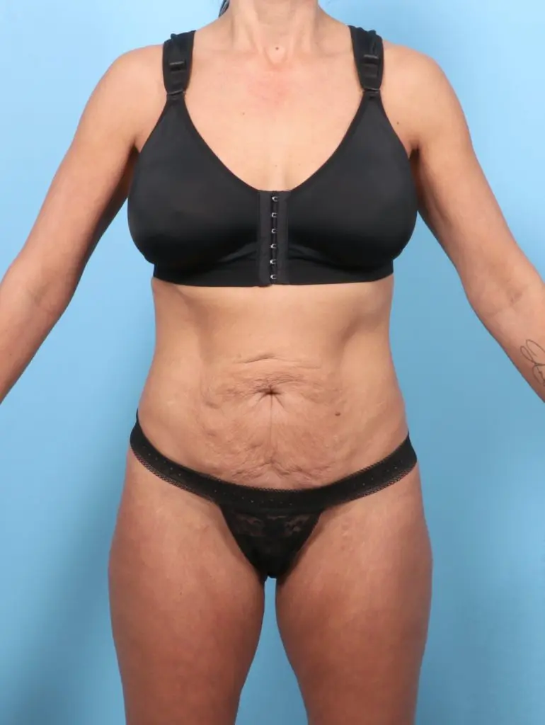 Tummy Tuck - Case 64047 - Before