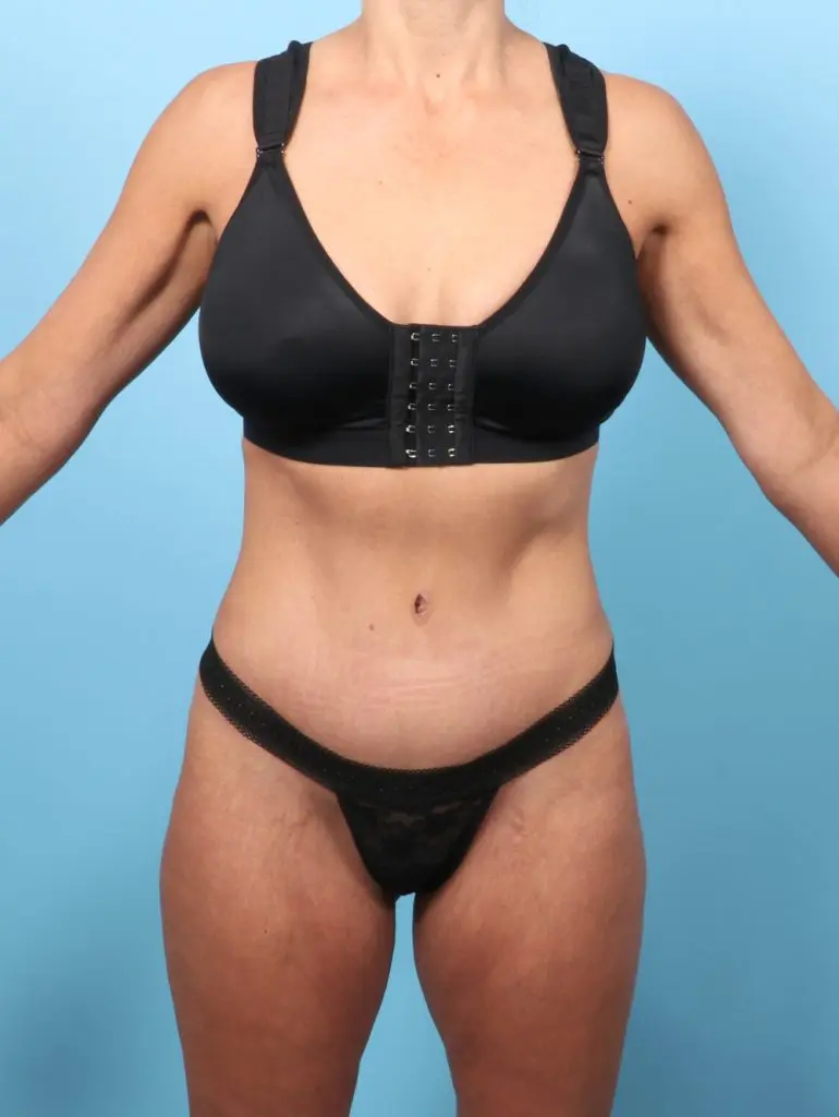 Tummy Tuck - Case 64047 - After