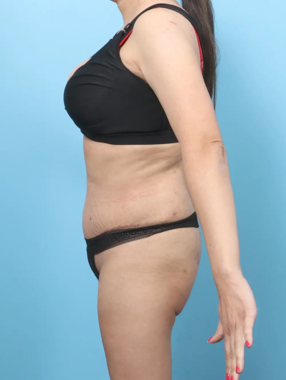 Tummy Tuck Patient Photo - Case 64059 - before view-2