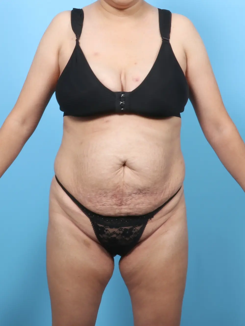 Tummy Tuck Patient Photo - Case 64059 - before view-