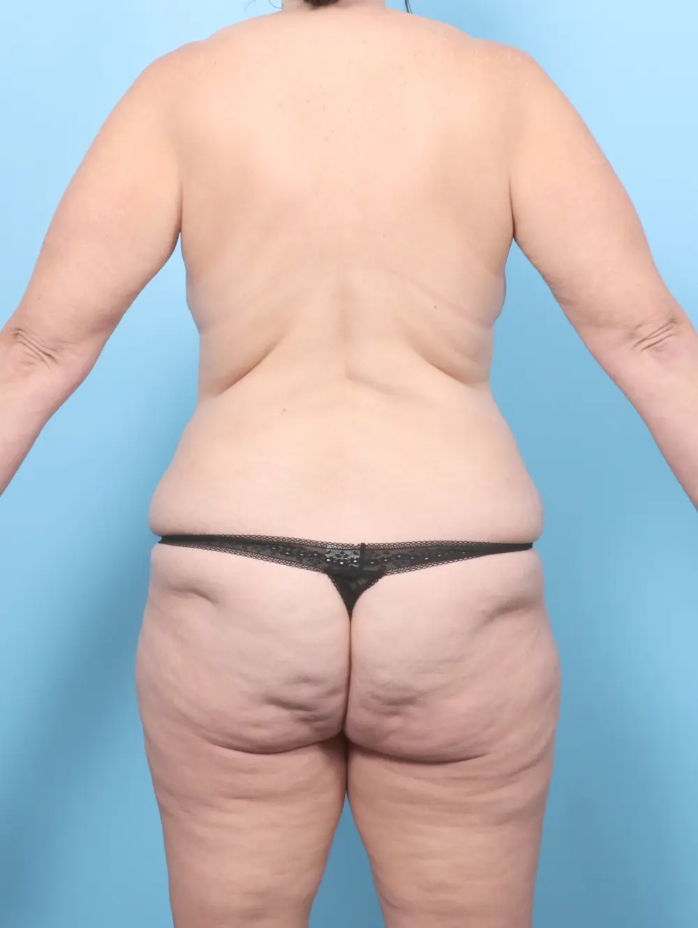After Weight Loss Patient Photo - Case 64099 - before view-3