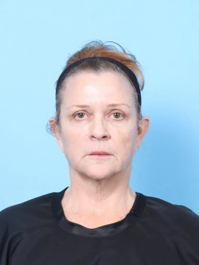 Facelift / Neck Lift - Case 64129 - Before