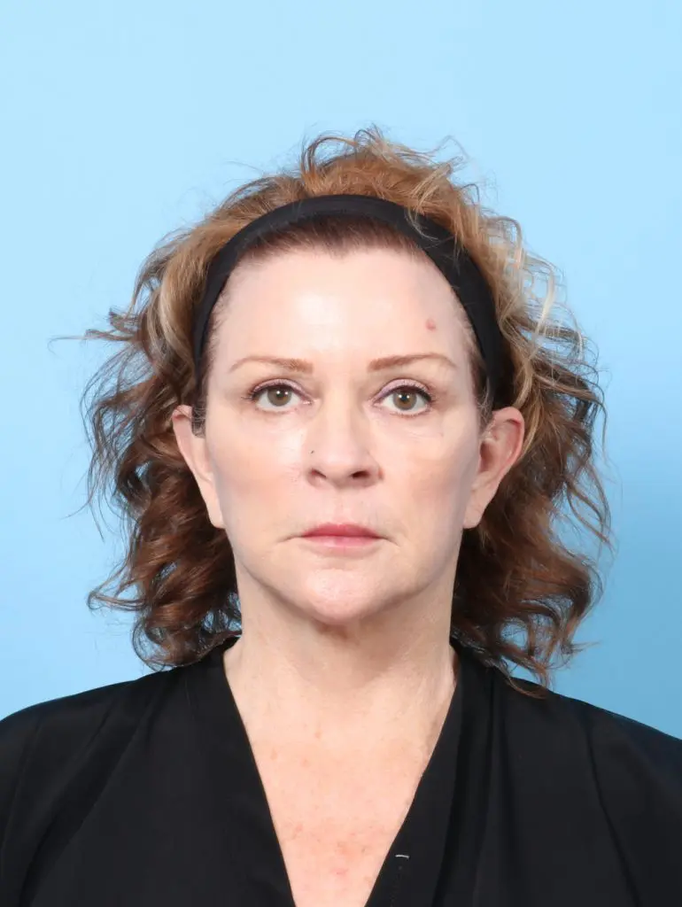 Facelift / Neck Lift - Case 64129 - After