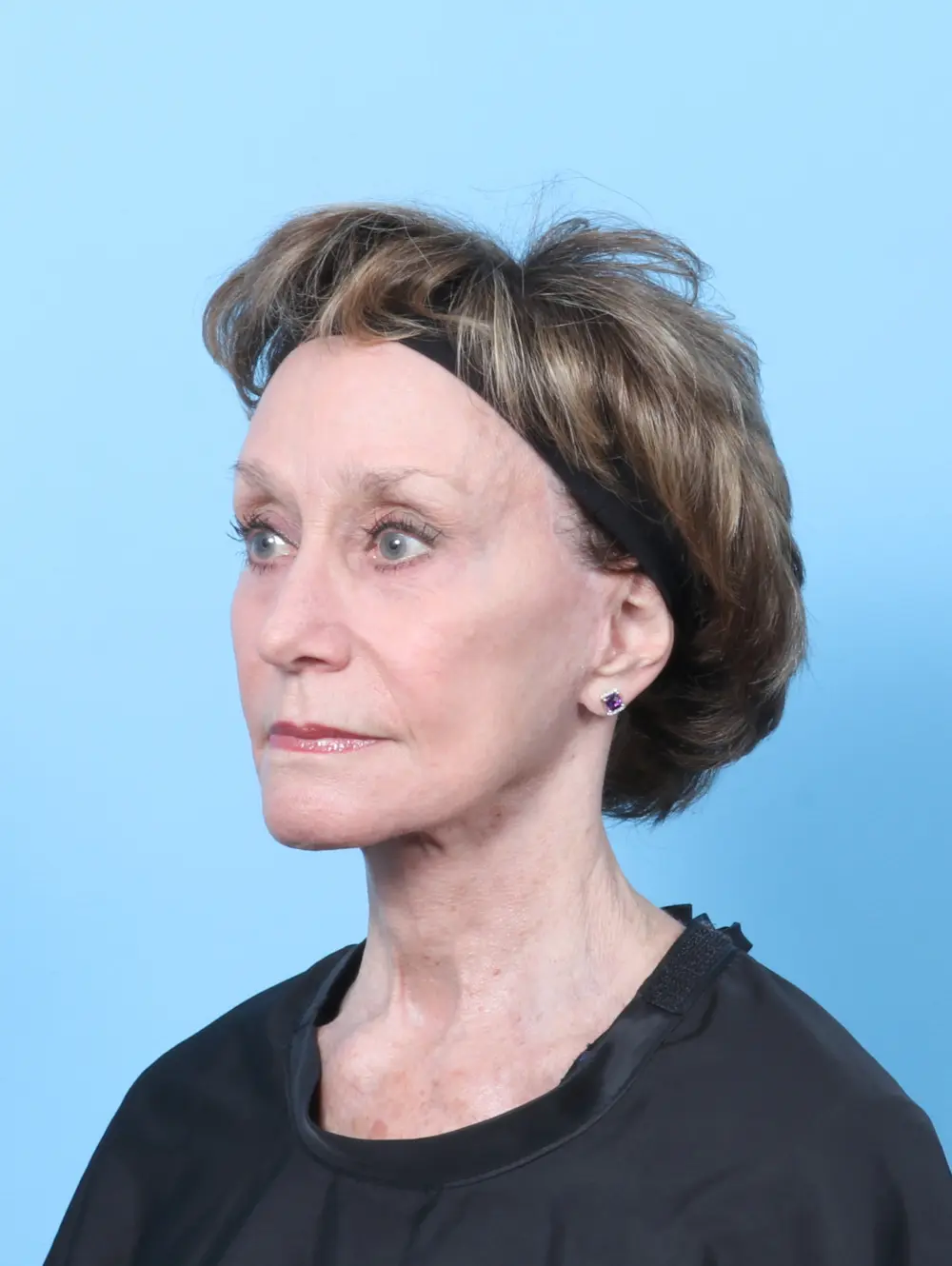 Facelift / Neck Lift Patient Photo - Case 64139 - after view-1