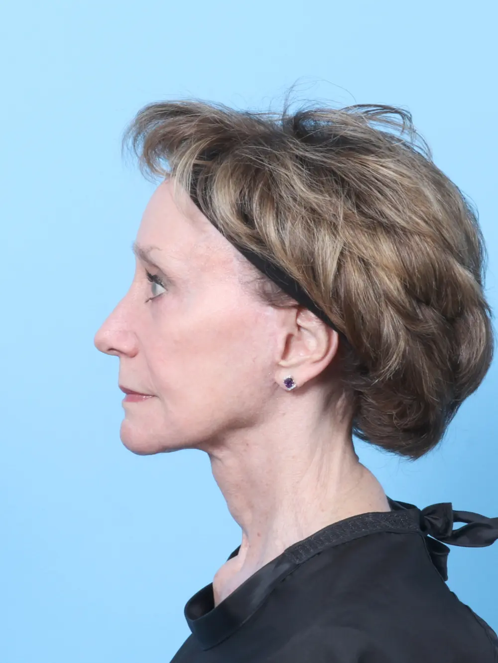 Facelift / Neck Lift Patient Photo - Case 64139 - after view-2