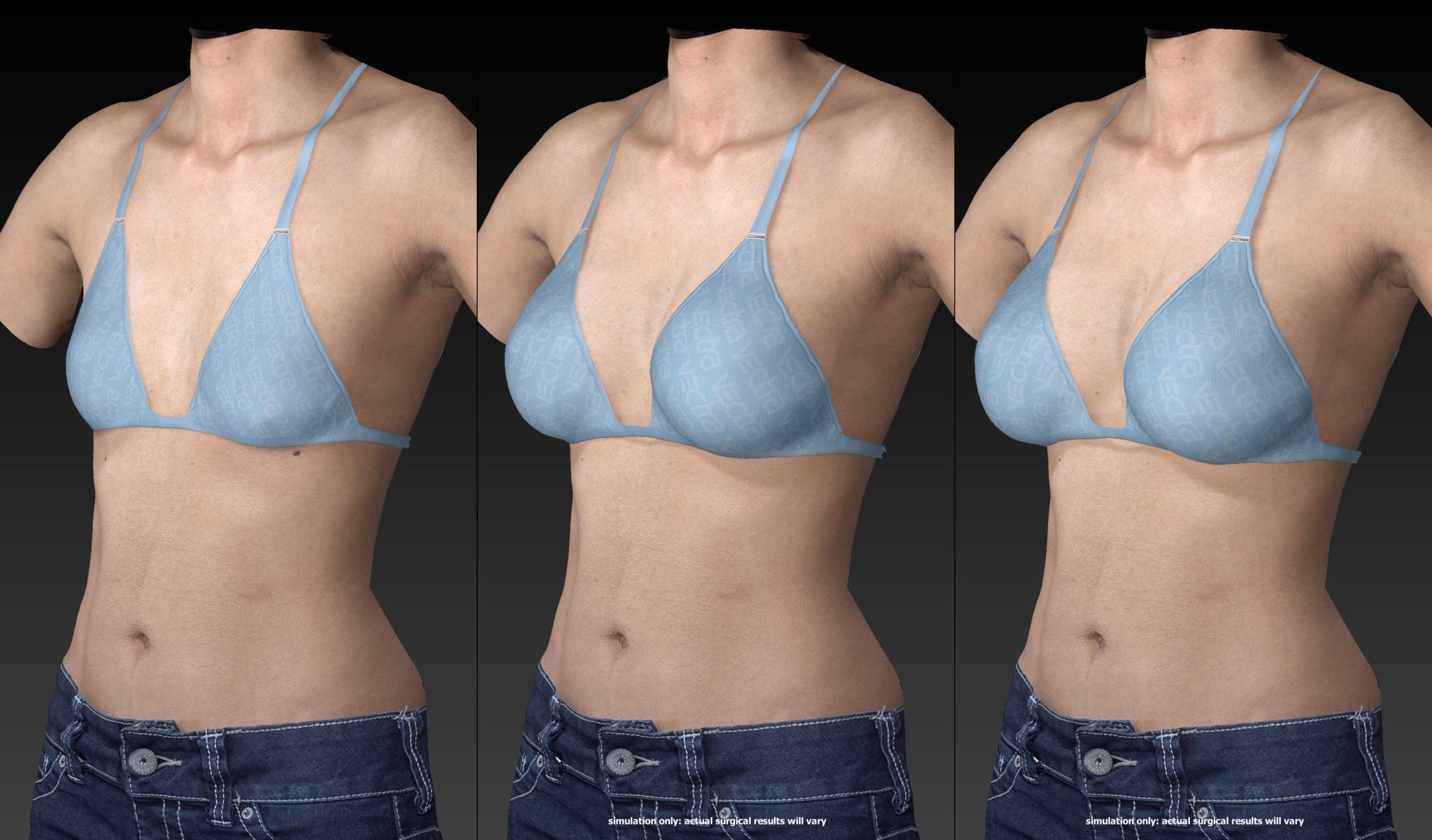Vectra 3D Breast Imaging Sacramento - The Natural Result