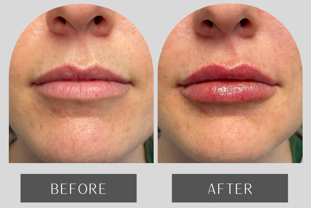 4 Easy Facts About Lip Fillers - Lip Injections In Walnut Creek, Ca - Dr. Haena Kim Shown thumbnail