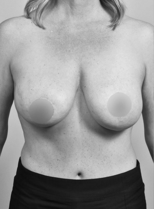 Before Breast Implants