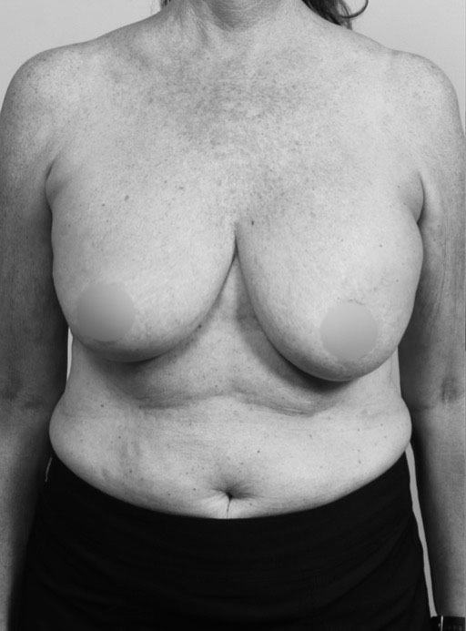 Double Bubble Breast Implant Deformity