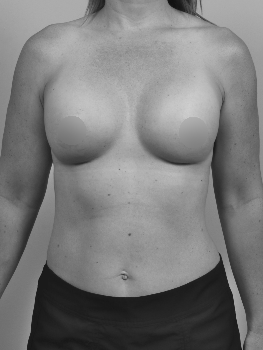 The process of 'drop and fluff' – how implants settle following breast  augmentation