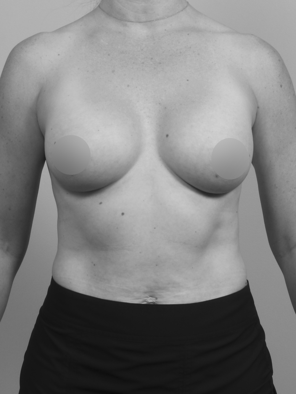 Correct Sagging Breasts Post-Pregnancy with a Breast Lift - Folsom