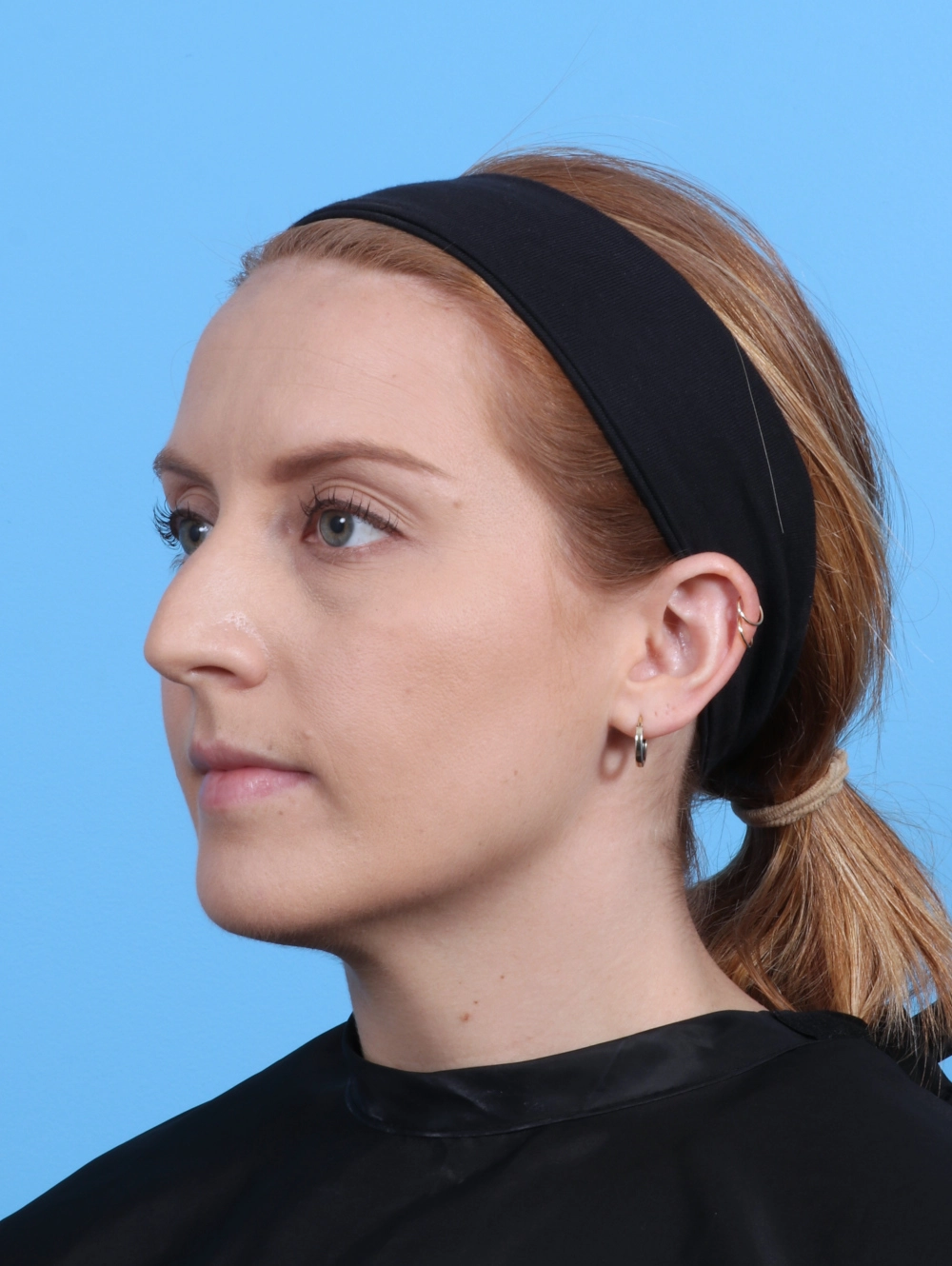Rhinoplasty Patient Photo - Case 30193 - before view-1