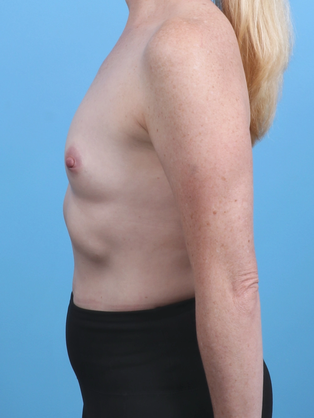 Breast Augmentation Patient Photo - Case 30294 - before view-2