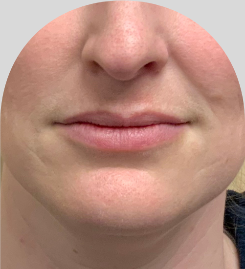 Lip Fillers - Case 53195 - Before