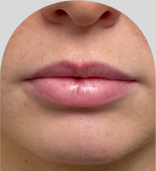 Lip Fillers - Case 53199 - Before